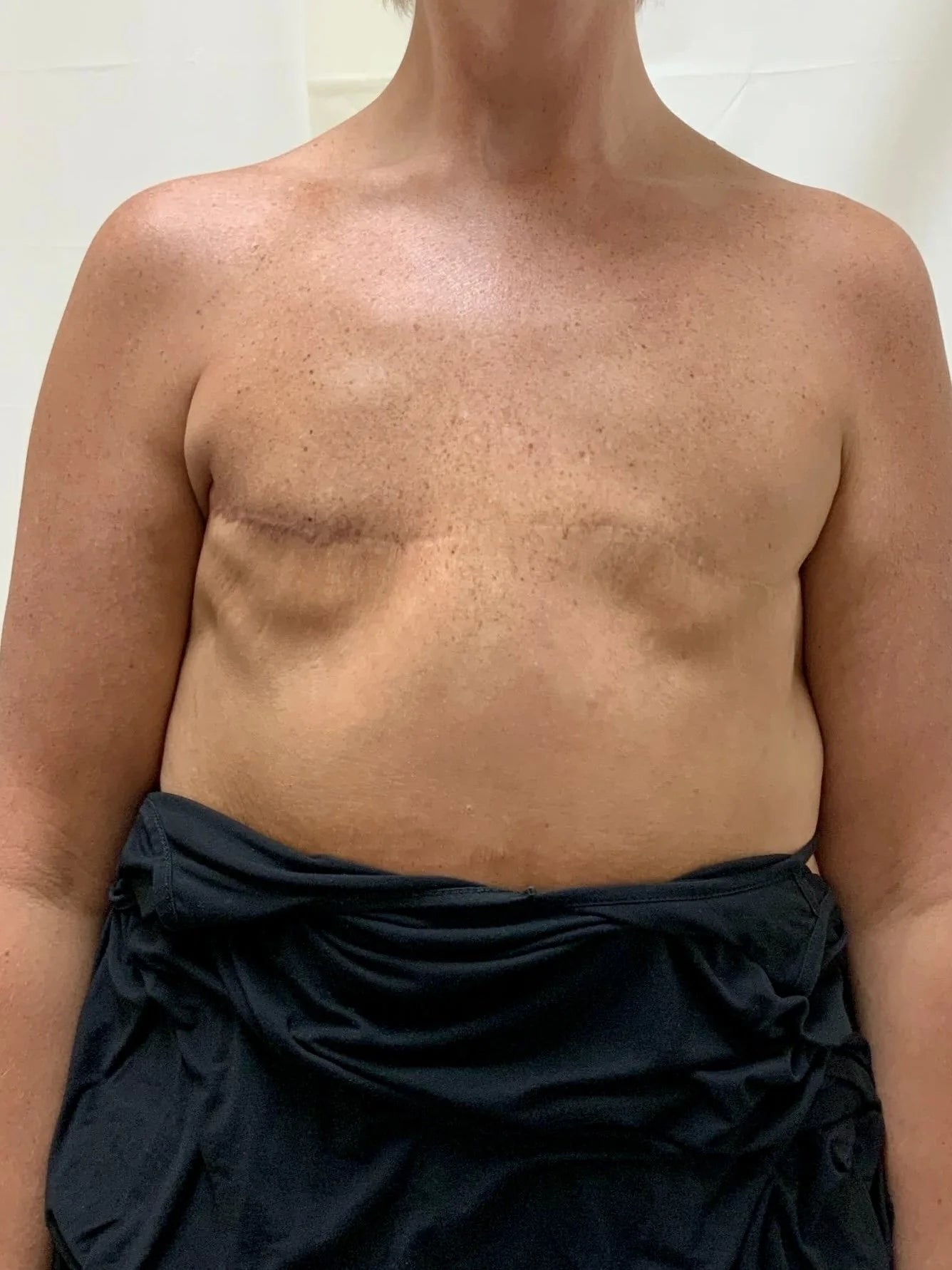 Post Mastectomy Transformation