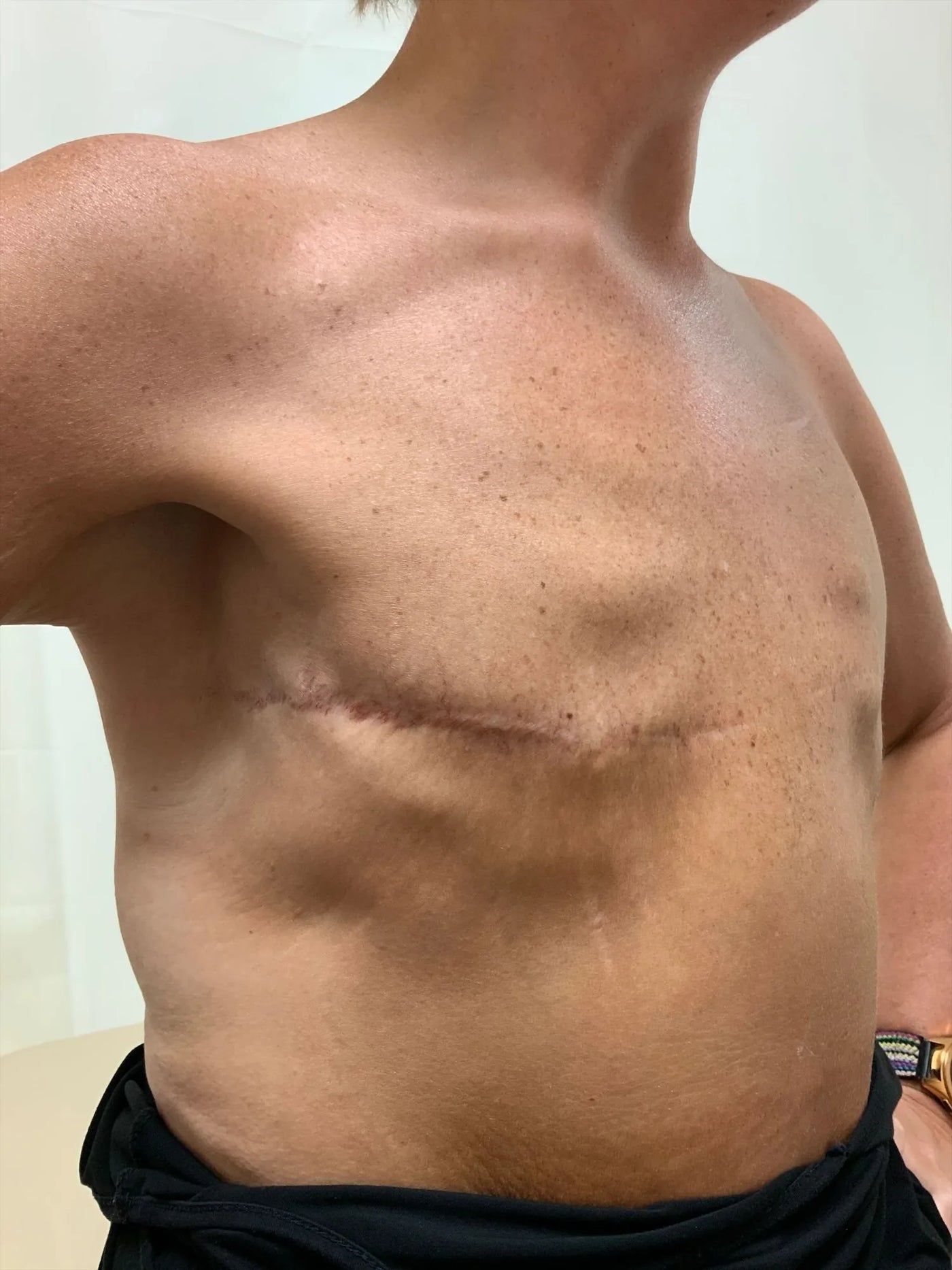Post Mastectomy Transformation